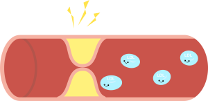 動脈硬化イメージ